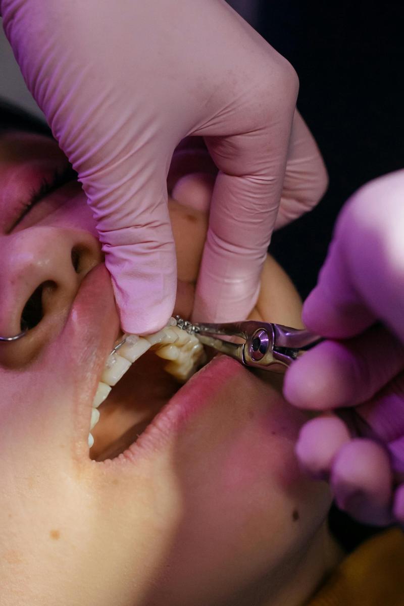 dental mouthguards
