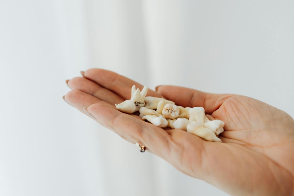 tooth extraction